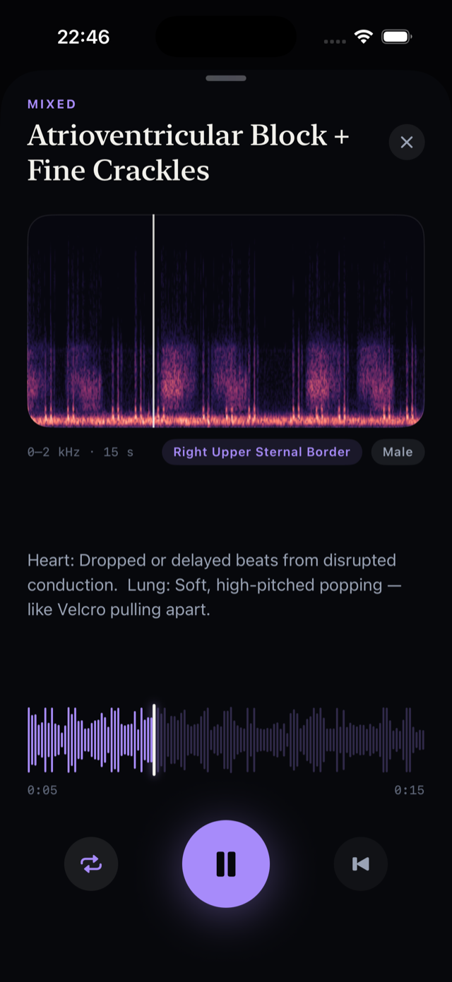 Spectrogram of mixed AV block and fine crackles recording at right upper sternal border
